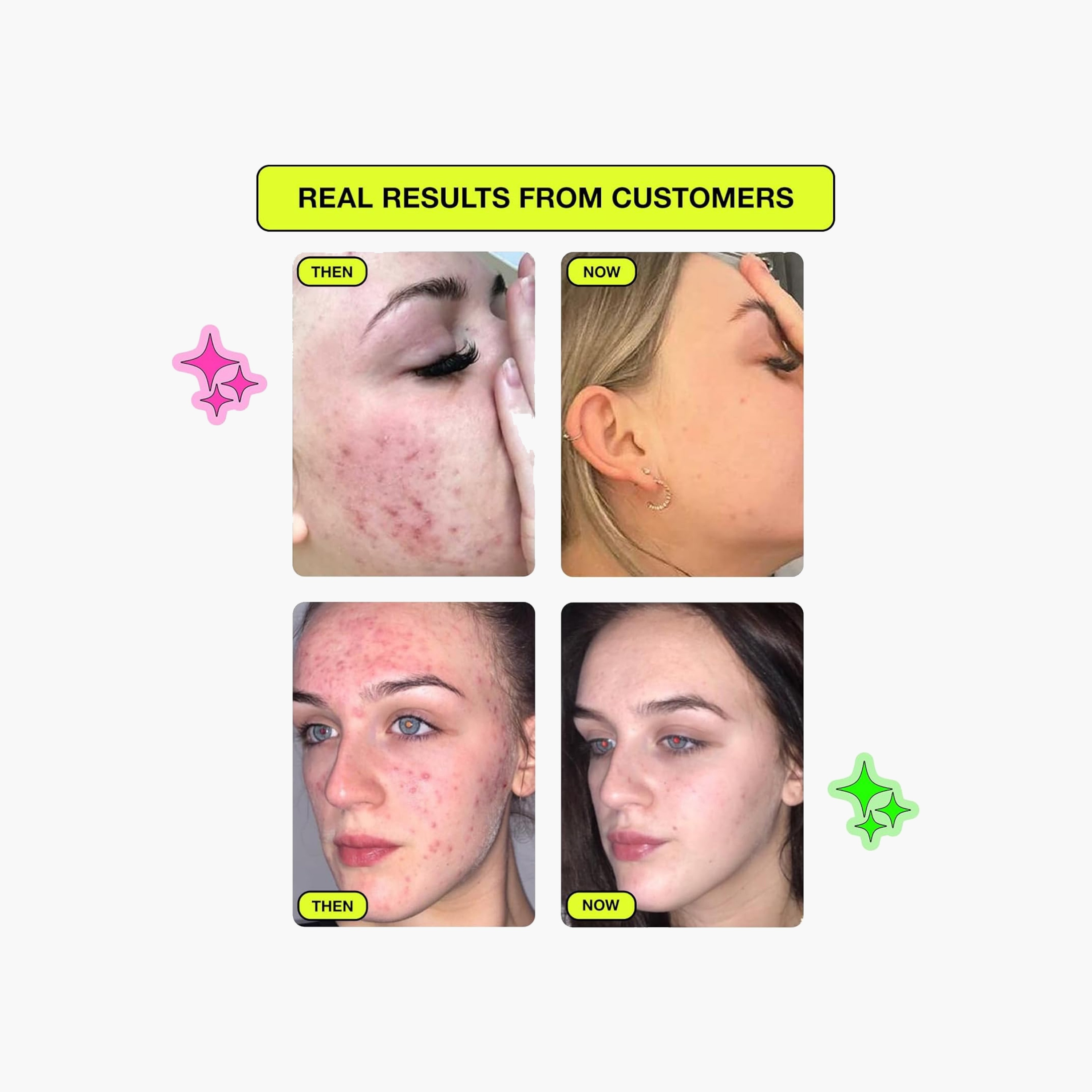 Carbon Theory Salicylic Acid Spot Patches-beautyandpersonalcare-skin-masks-facepads-image-3