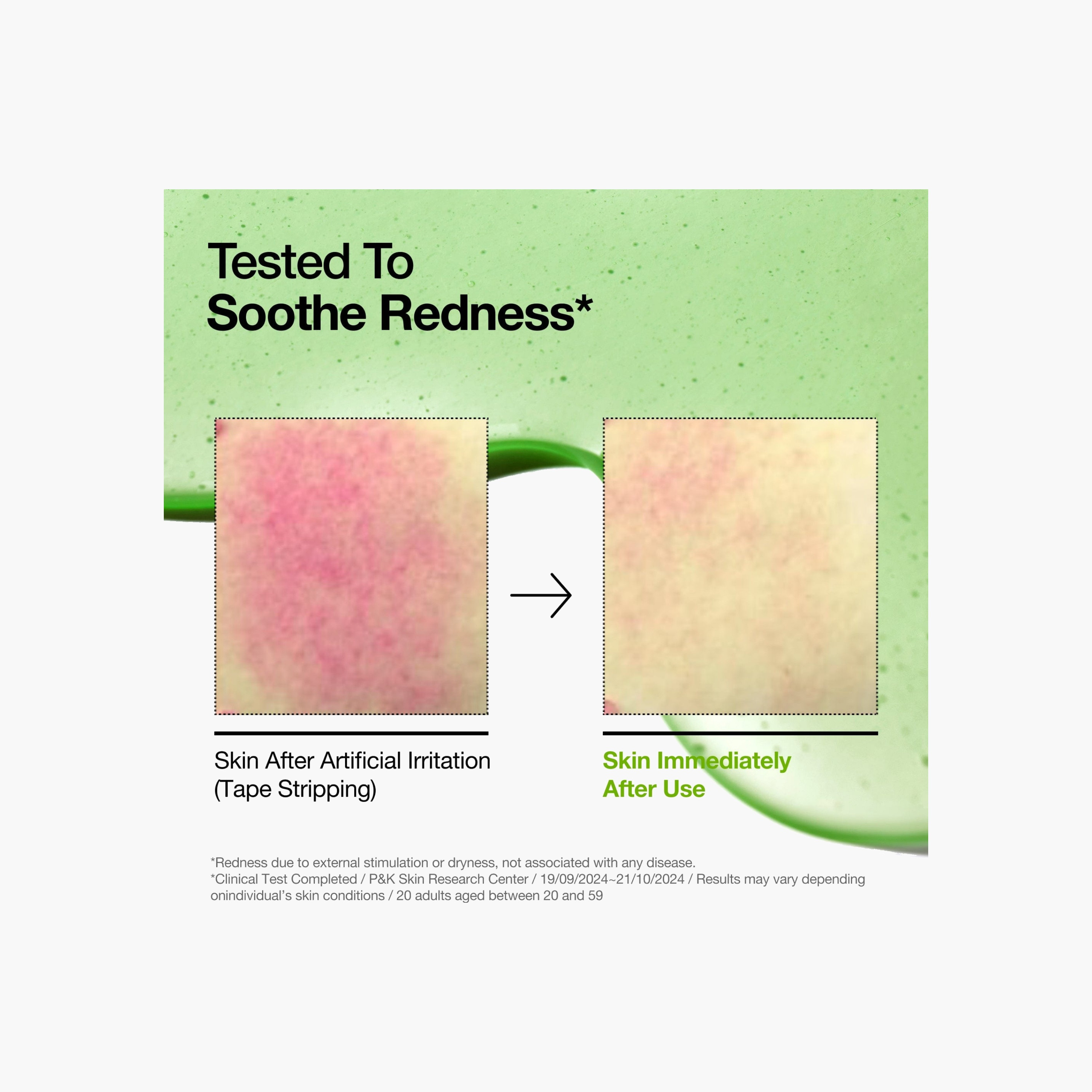 ANUA Azelaic Acid Redness Soothing Serum-beautyandpersonalcare-kbeauty-skin-treatmentsandserums-image-2