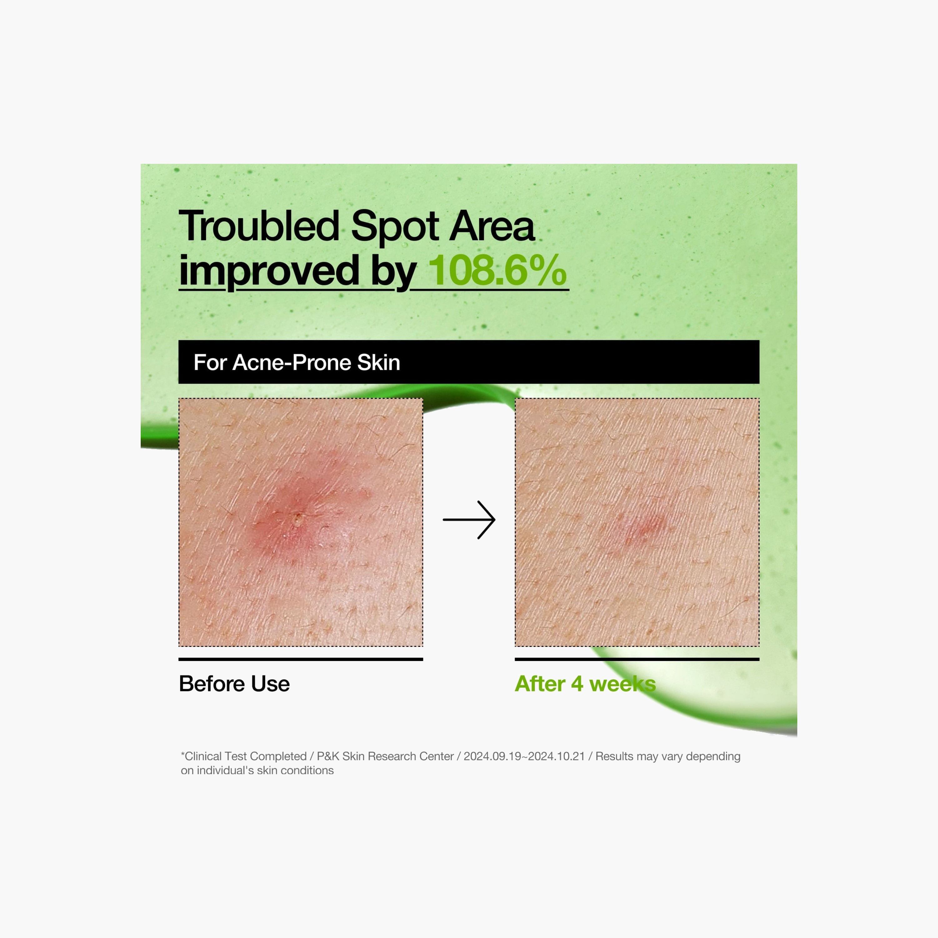ANUA Azelaic Acid Redness Soothing Serum-beautyandpersonalcare-kbeauty-skin-treatmentsandserums-image-3